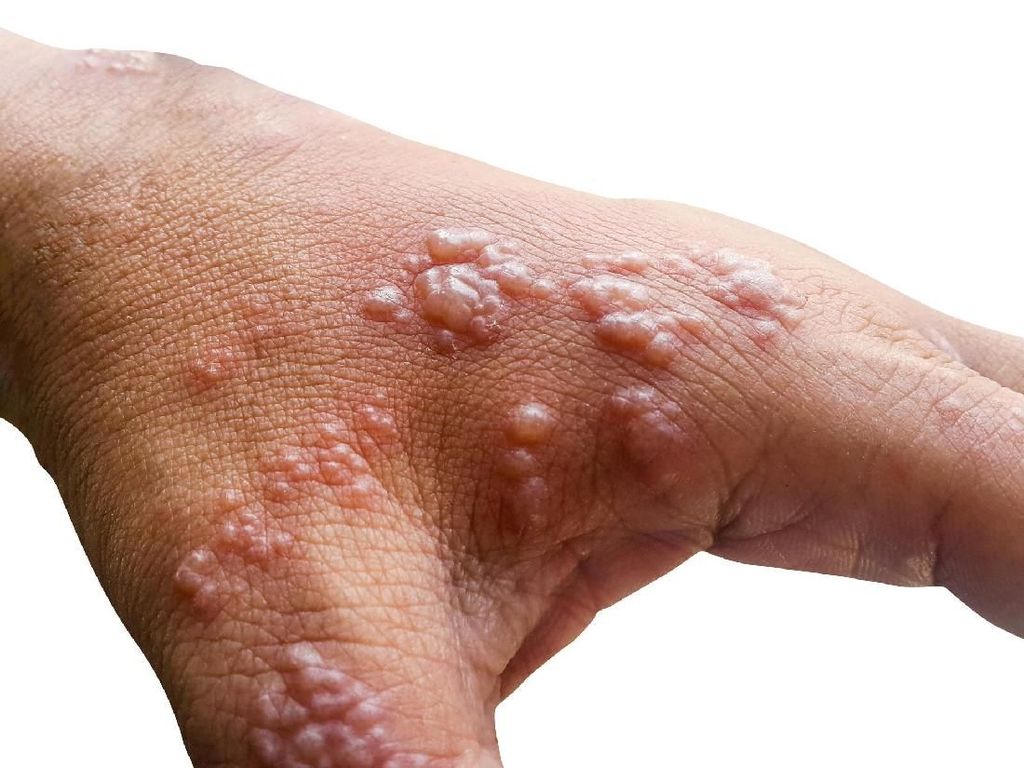 Kenali Gejala Herpes Zoster, Penyebab, dan Cara Mengobatinya Kenali Gejala Herpes Zoster, Penyebab, dan Cara Mengobatinya
