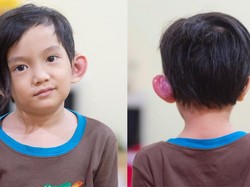 Sinus Preauricular, Kondisi yang Bikin Telinga Anak Anji Merah dan Bengkak