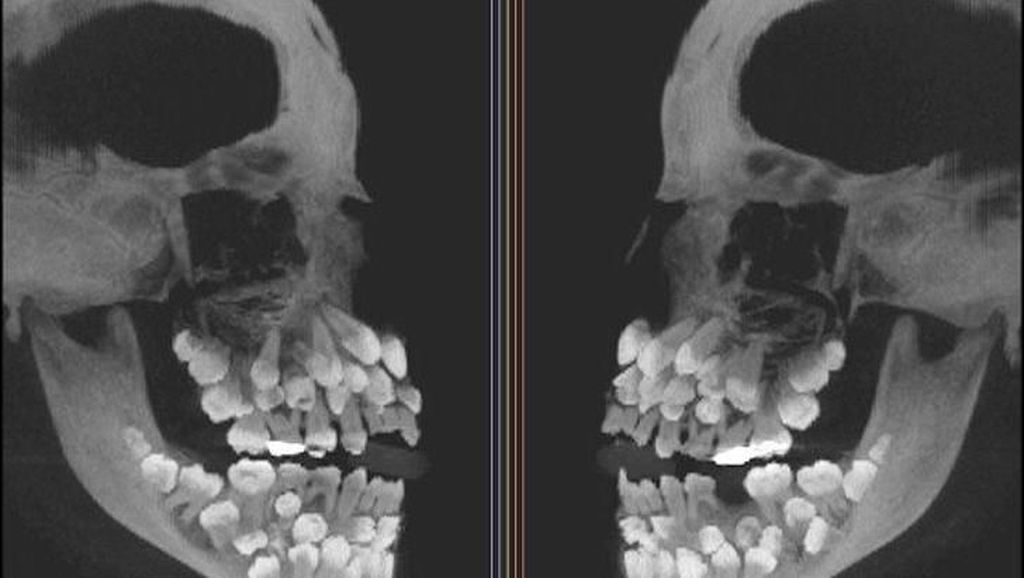 10 Foto yang Pernah Tertangkap X-Ray dari Tubuh Manusia, Bikin Merinding!