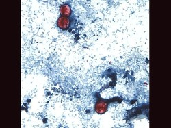 Cerita Dua Pasien Kena Meningitis Gara-gara Makan Lipan Mentah