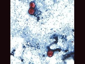 Cerita Dua Pasien Kena Meningitis Gara-gara Makan Lipan Mentah Cerita Dua Pasien Kena Meningitis Gara-gara Makan Lipan Mentah