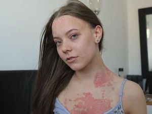 Dikritik Punya Ruam Merah di Kulit, Wanita Ini Beri Pesan Inspiratif