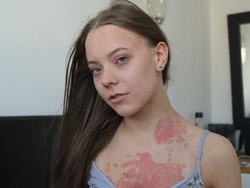 Dikritik Punya Ruam Merah di Kulit, Wanita Ini Beri Pesan Inspiratif