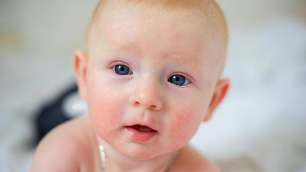 Kulit bayi gatal, dermatitis atopik