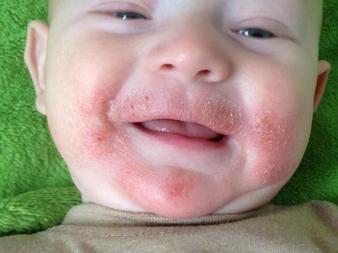 Kenali Dermatitis Atopik yang Bikin Kulit Bayi Gatal/