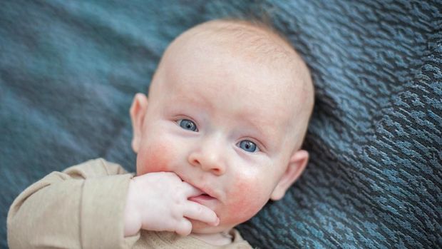 ilustrasi dermatitis atopik pada bayi/