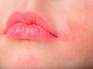 Hal-hal yang Harus Dihindari Supaya Anak Tak Kena Dermatitis Atopik Hal-hal yang Harus Dihindari Supaya Anak Tak Kena Dermatitis Atopik