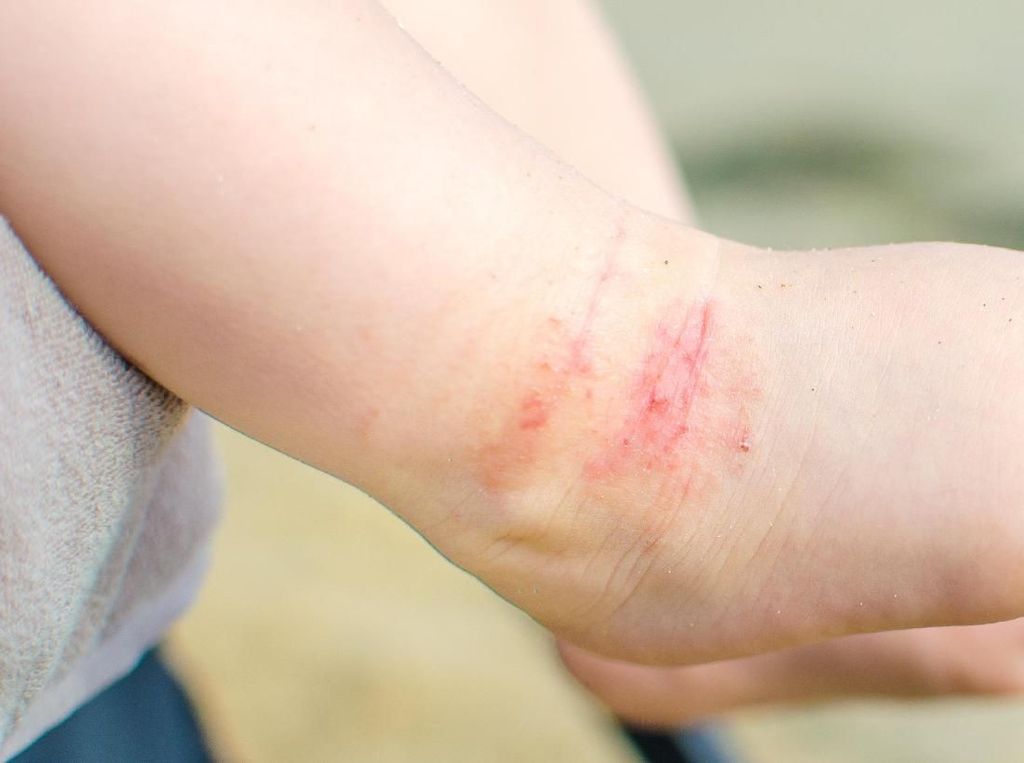 Kena Dermatitis Atopik Sampai Luka, Bagaimana Supaya Cepat Sembuh?