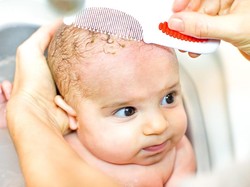 Cradle Cap, Penyebab Kepala Bayi Berkerak Seperti Ketombe