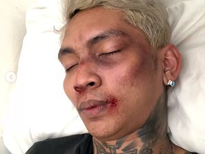 Ini Pengakuan Young Lex Soal Foto Wajah Babak Belur