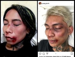 Dibully Netizen, Young Lex Senang Ada Banyak Meme Wajah Babak Belurnya