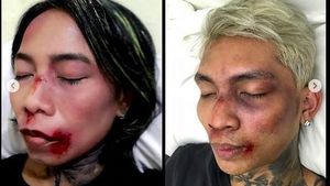 Kocak! Aksi Fans Meniru Wajah Babak Belur Young Lex