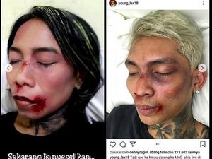 Kocak! Aksi Fans Meniru Wajah Babak Belur Young Lex Kocak! Aksi Fans Meniru Wajah Babak Belur Young Lex