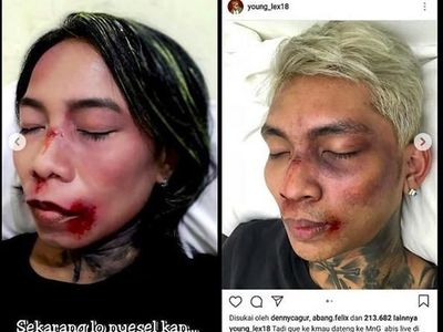 Kocak! Aksi Fans Meniru Wajah Babak Belur Young Lex