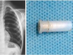 Bocah di Bandung Bersuara Terompet Karena Telan Peluit, Berbahayakah?