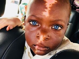 Mereka Bermata Biru Indah Karena Sindrom Waardenburg Mereka Bermata Biru Indah Karena Sindrom Waardenburg