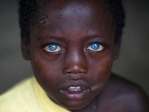 Idap Sindrom Waardenburg, Bocah Ini Punya Mata Biru yang Sangat Indah