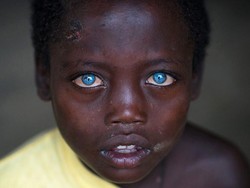 Idap Sindrom Waardenburg, Bocah Ini Punya Mata Biru yang Sangat Indah