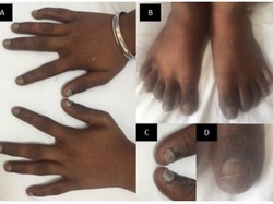 Penampakan Kuku Menghitam Akibat Kekurangan Vitamin B12