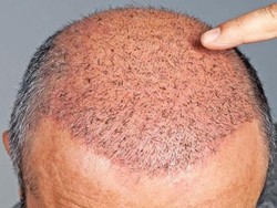 Rambut Rontok dan Rapuh Bisa Cepat Diatasi dengan Cara Ini