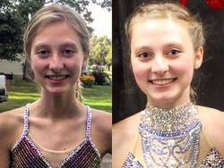 Idap Anoreksia, Berat Badan Wanita Ini Sempat Hanya 33 Kg