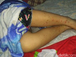 Usai Imunisasi MR, Siswi SD di Pangkalpinang Tak Bisa Jalan