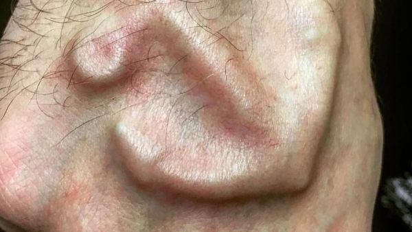 Keren atau Geli? Potret Tato Implan yang Menyembul di Kulit