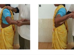 Idap Sindrom Langka, Wanita Ini Bisa Putar Lengan 180 Derajat