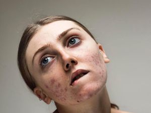 Ada Pesan Positif di Balik Model yang Bangga Pamer Foto Penuh Jerawat