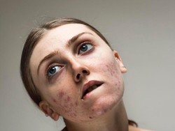 Ada Pesan Positif di Balik Model yang Bangga Pamer Foto Penuh Jerawat