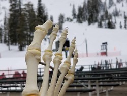 Kaki Amputasi Korban Kanker Bisa Keliling Dunia dan Punya Akun Instagram