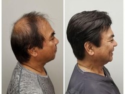 Rambut Rontok dan Rapuh Bisa Cepat Diatasi dengan Cara Ini