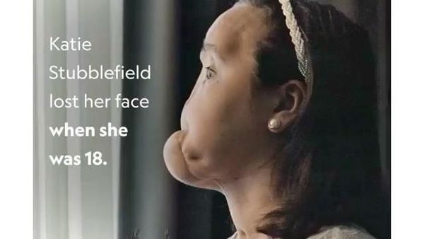 Potret Transformasi Wanita Muda Penerima Transplantasi Wajah