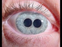 Mengenal Polycoria, Satu Mata Memiliki Dua Pupil atau Lebih