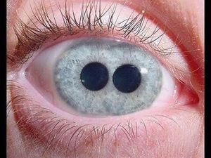 Mengenal Polycoria, Satu Mata Memiliki Dua Pupil atau Lebih Mengenal Polycoria, Satu Mata Memiliki Dua Pupil atau Lebih