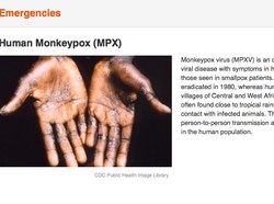 Vaksin Varicella Proteksi 80 Persen Tubuh Manusia dari Cacar Monyet