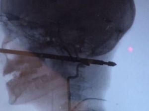 Kepala Bocah Ini Tertancap Penusuk Daging, Ajaibnya Selamat