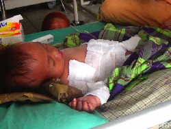 Balita di Bone Tersiram Air Panas, Keluarga Kesulitan Biaya RS