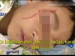 Viral Bocah di Karawang Matanya Berdarah, Benarkah Kelamaan Main Gadget?