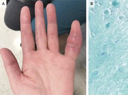 Kelingking Wanita Ini Bengkak, Ternyata Tanda Infeksi Tuberkulosis