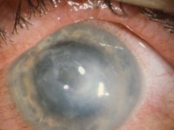 Muncul Wabah Infeksi Mata Langka di Antara Pengguna Softlens