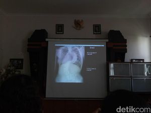 Bahagianya Febi Lepas dari Derita Punggung Melengkung 100 Derajat