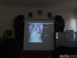 Pertama di Bali, RSUP Sanglah Sukses Mengoperasi Skoliosis Langka