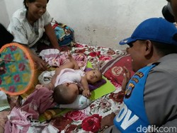 Bayi Kembar Siam di Gunungkidul Hanya Punya 1 Usus Besar
