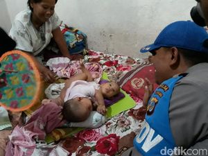 Bayi Kembar Siam di Gunungkidul Hanya Punya 1 Usus Besar Bayi Kembar Siam di Gunungkidul Hanya Punya 1 Usus Besar
