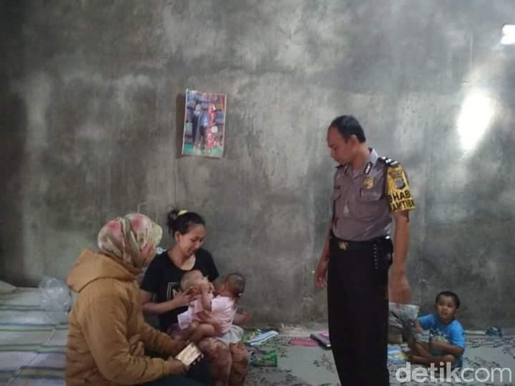 Dinsos Gunungkidul Rapat Cari Solusi untuk Bantu Bayi Kembar Siam