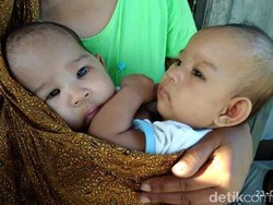 Menjenguk Meisya dan Meikha, Bayi Kembar Siam dari Gunungkidul