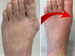 Temuan Revolusioner Ini Bisa Hilangkan Bunion dalam Beberapa Hari