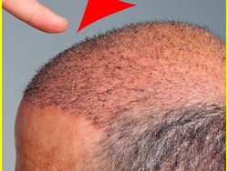 Peneliti Terkejut, Ada Metode yang Cepat Menumbuhkan Rambut