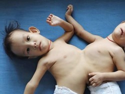 Kembar Siam dari Bhutan Akan Dipisahkan di Melbourne